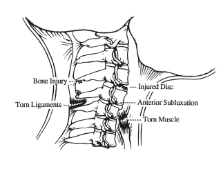 Injured Neck - Whiplash