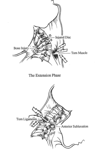 How Neck Injuries Occur